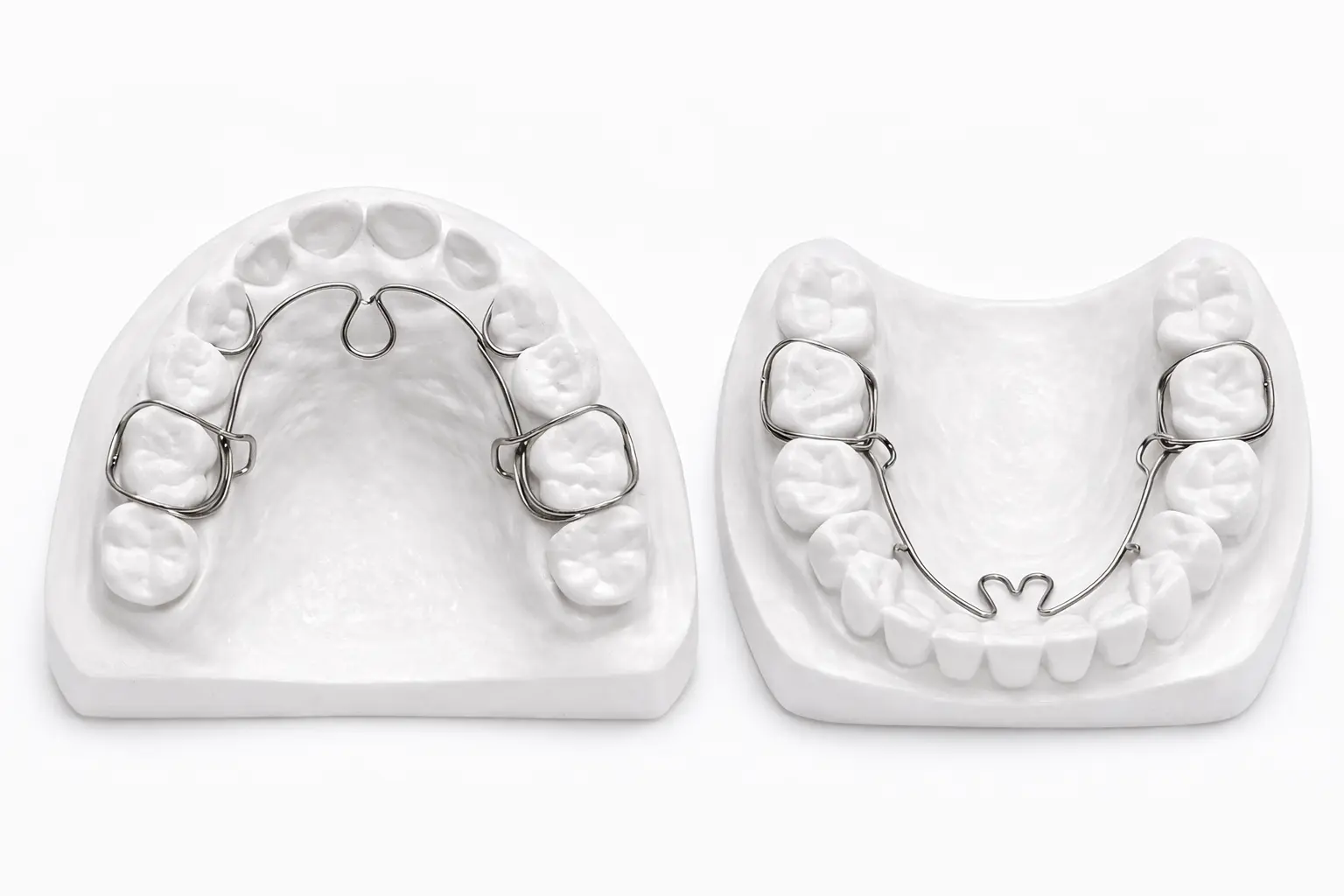 ALF (Advanced Lightwire Functional) appliance example