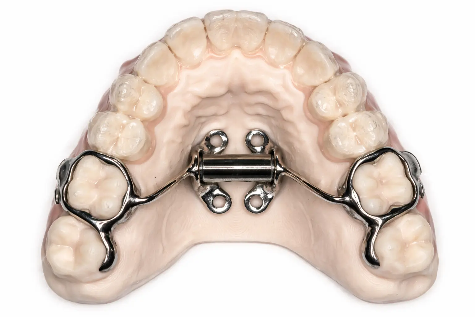Bone Supported Expander appliance photo