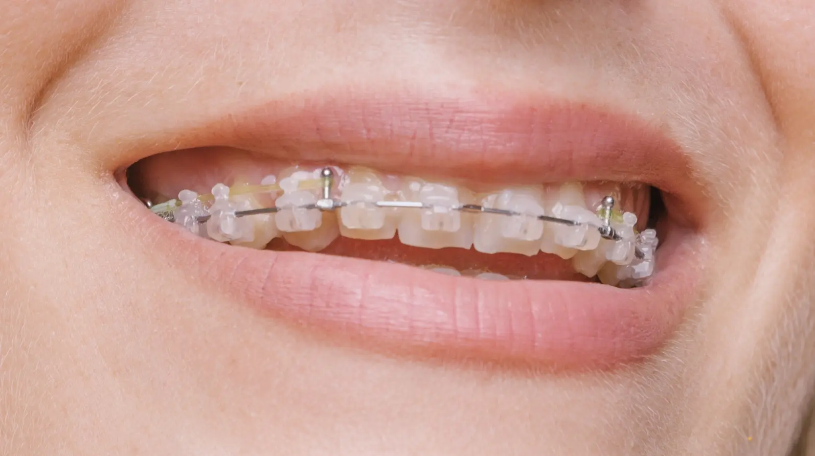 Ceramic braces detail