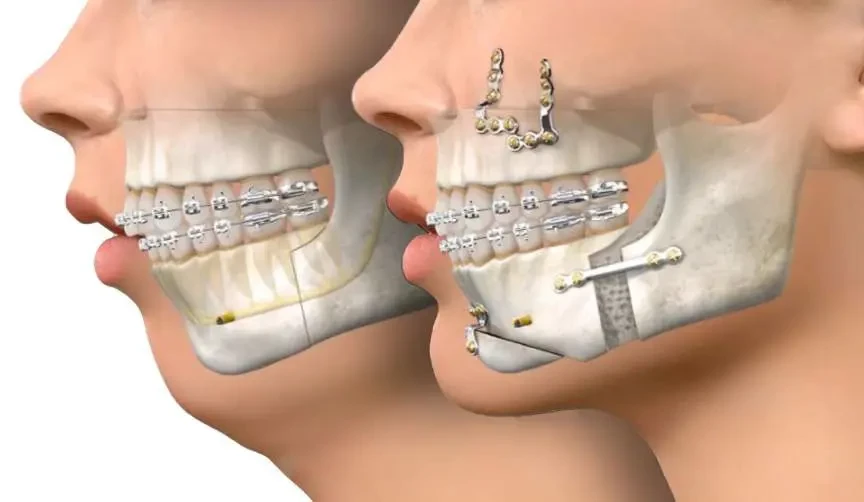 Illustration of double jaw surgery with upper and lower jaw repositioning
