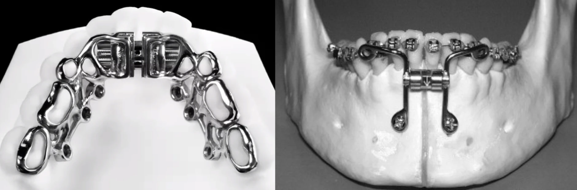 MSDO appliance photos showing a mandibular distraction device