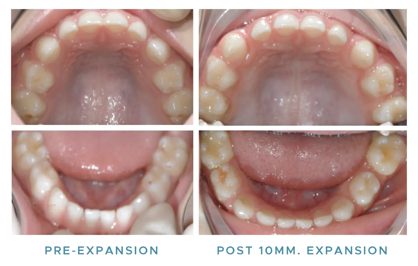 Pre-expansion and post 10 millimeter expansion clinical photos of upper and lower arches