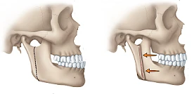 Illustration of surgery used to correct a protruding lower jaw