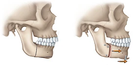 Illustration of surgery used to correct a receding lower jaw or weak chin