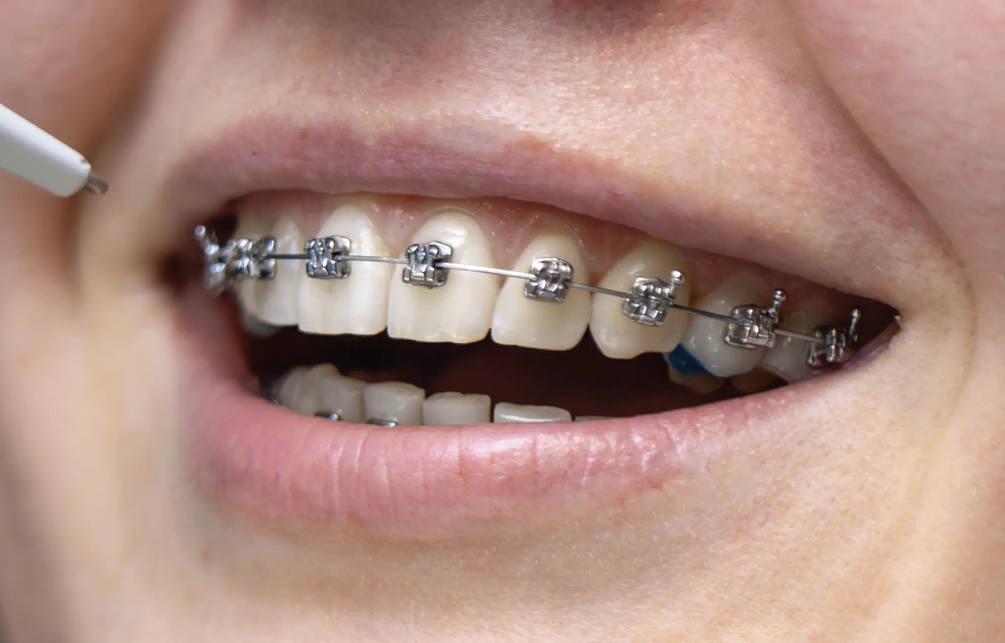 Self-ligating braces detail
