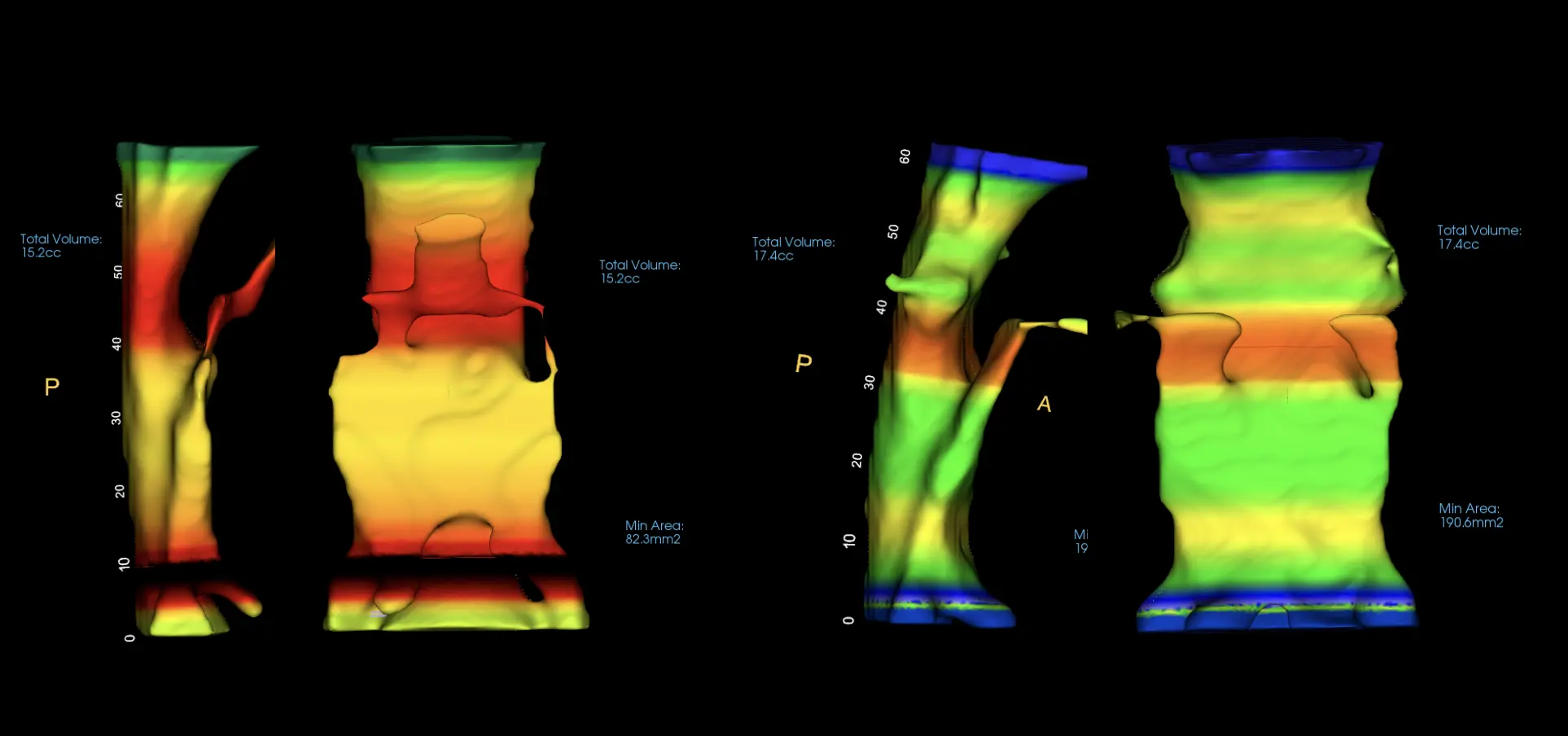 Color airway analysis showing before and after airway volume changes