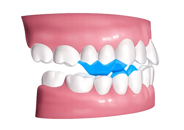 Mandibular advancement bite-jump appliance visual