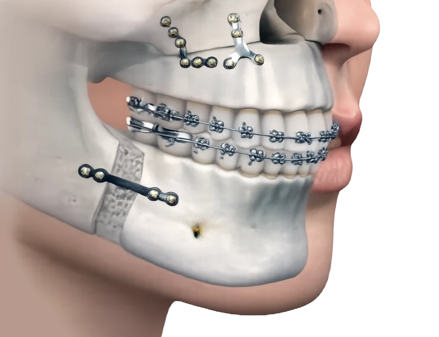 Illustration of jaw surgery with braces and fixation plates
