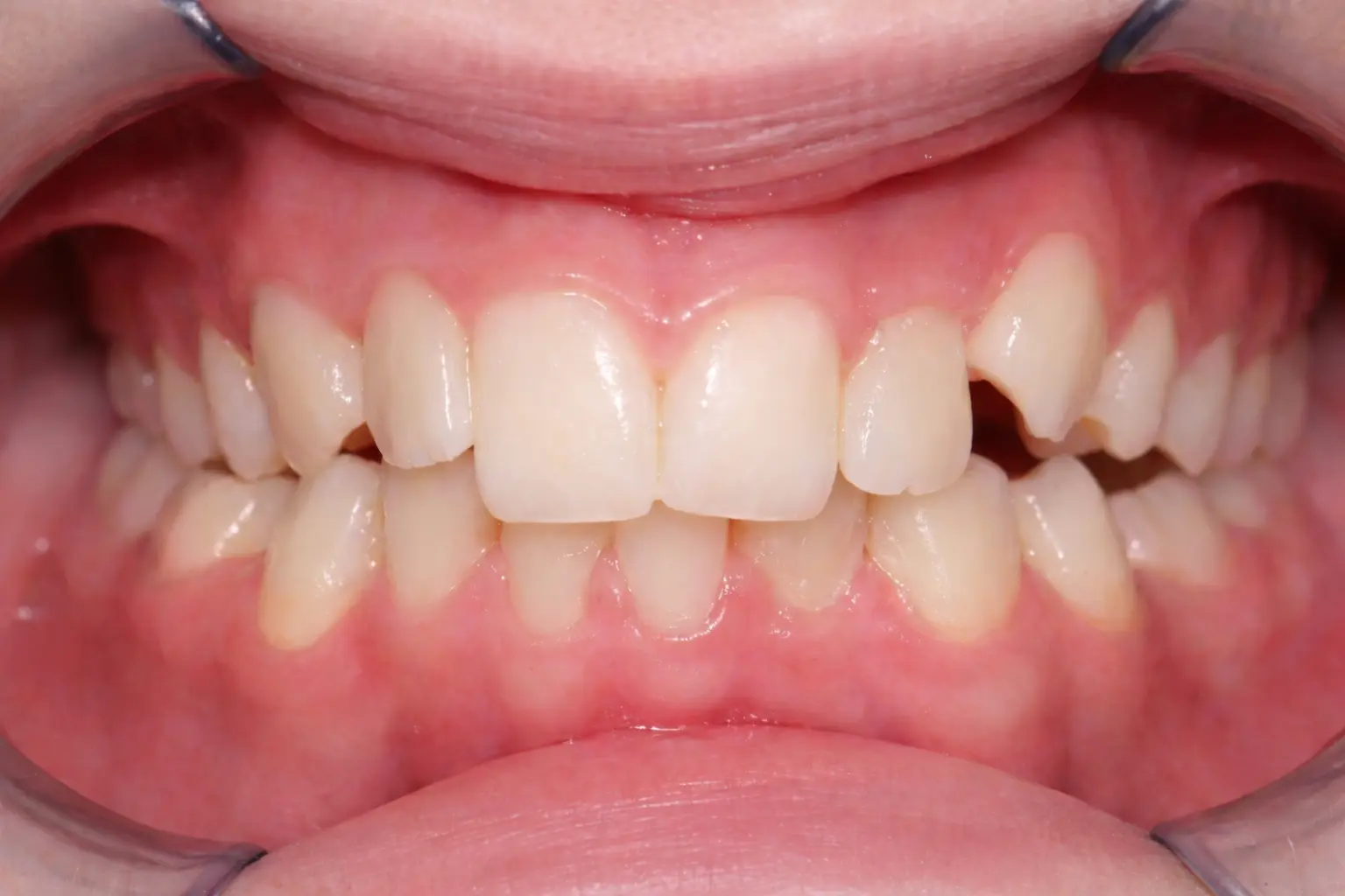Teen crossbite showing bite coordination mismatch