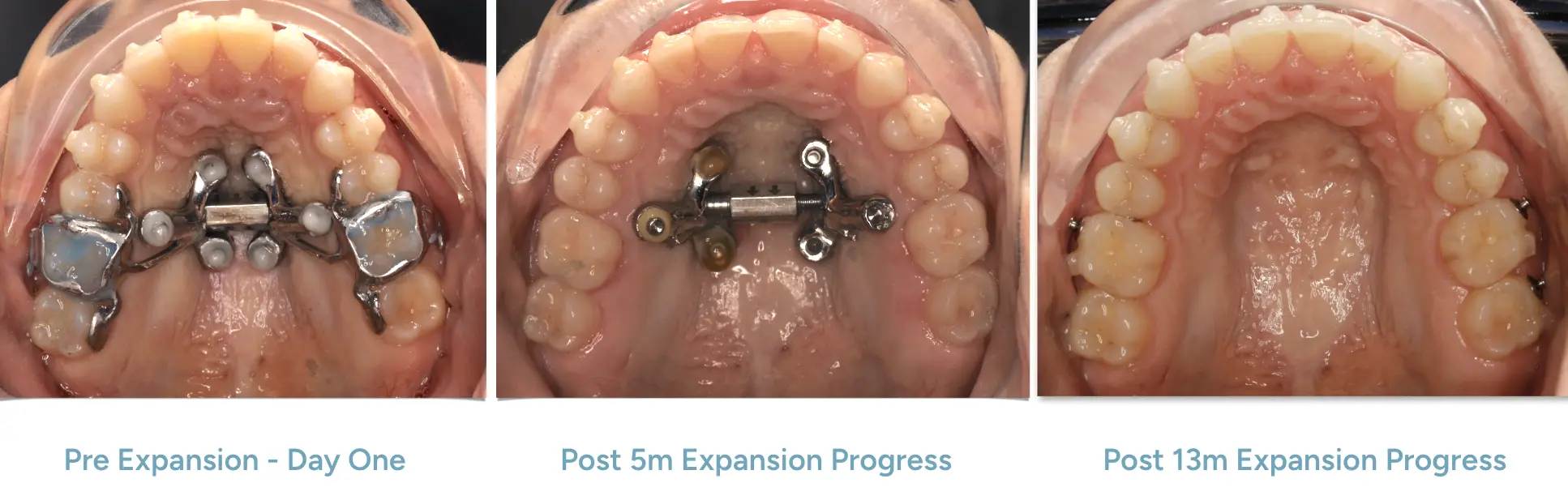 MARPE expansion progress over time