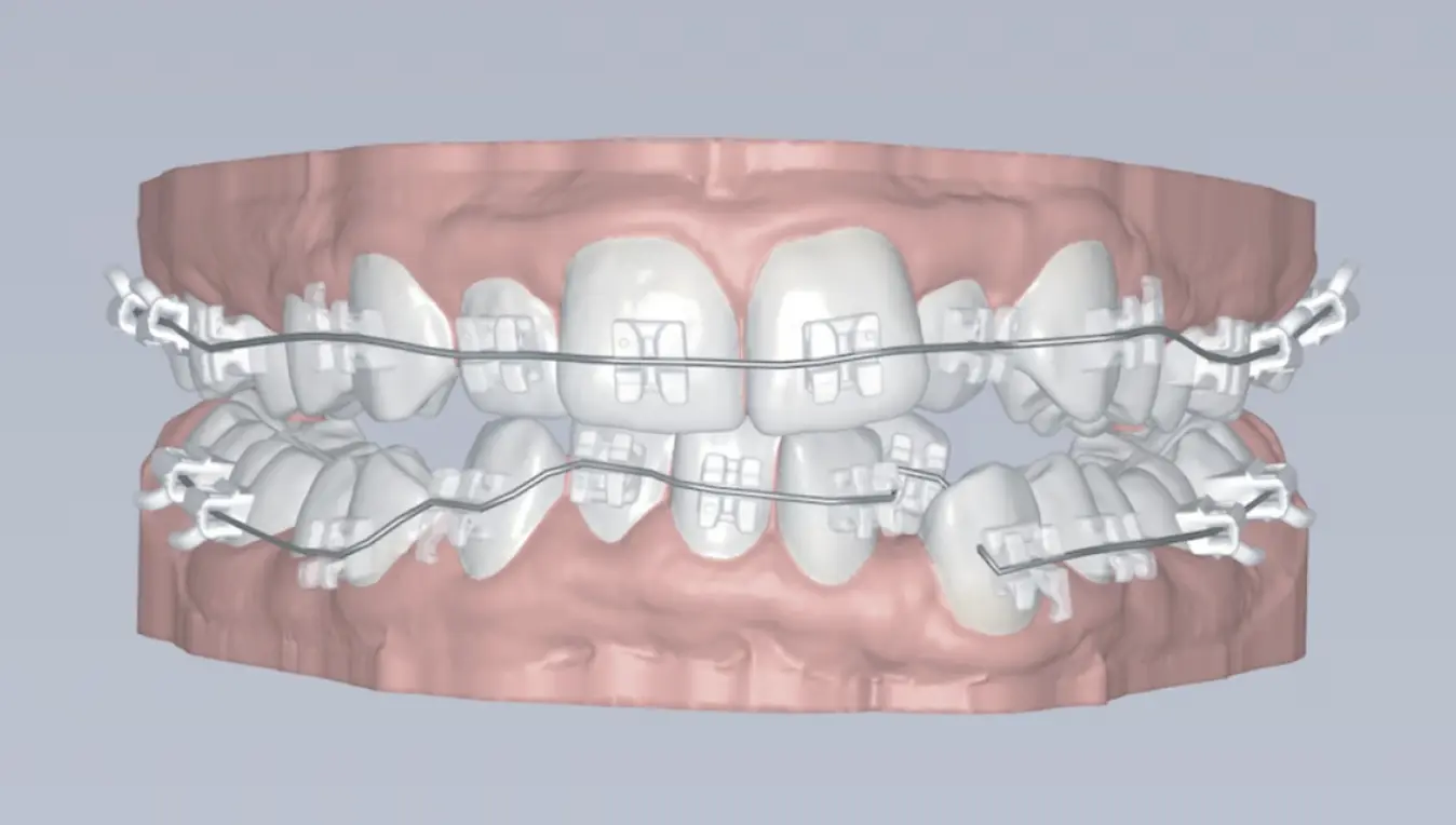 LightForce personalized fit comparison
