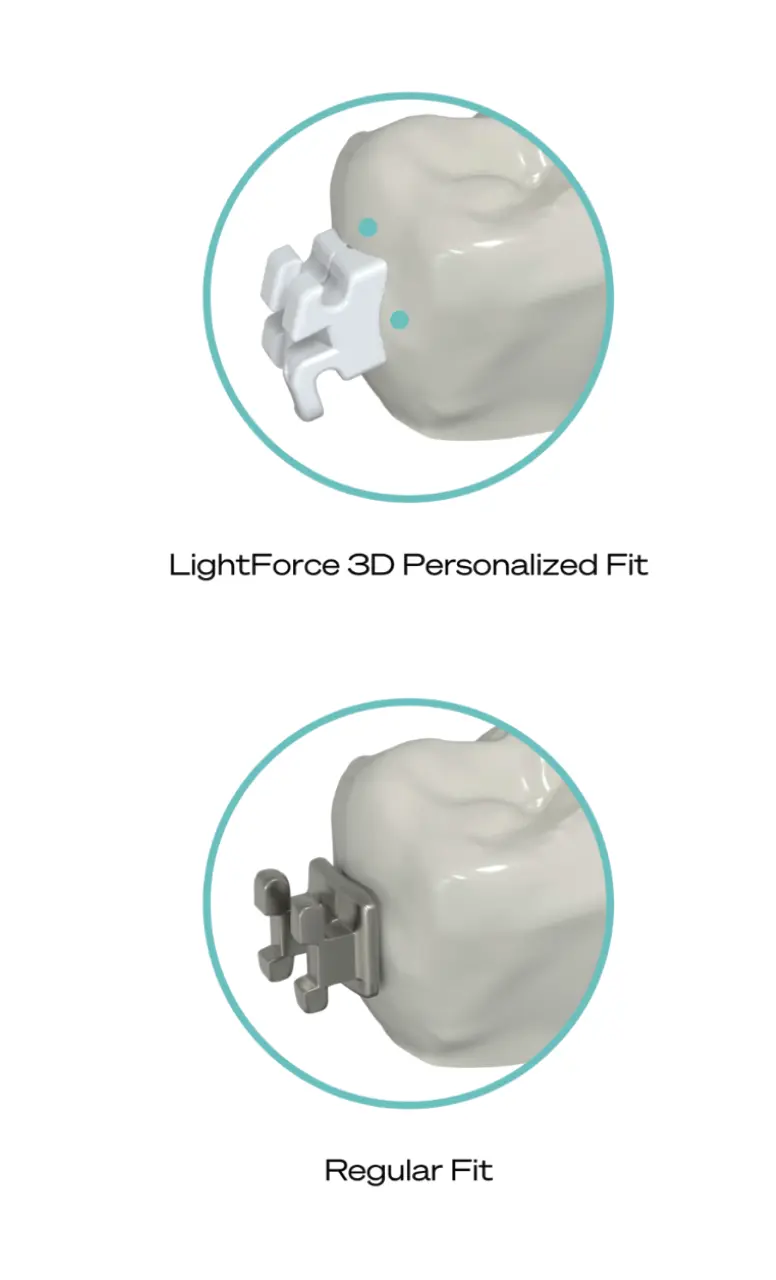 LightForce braces digital model
