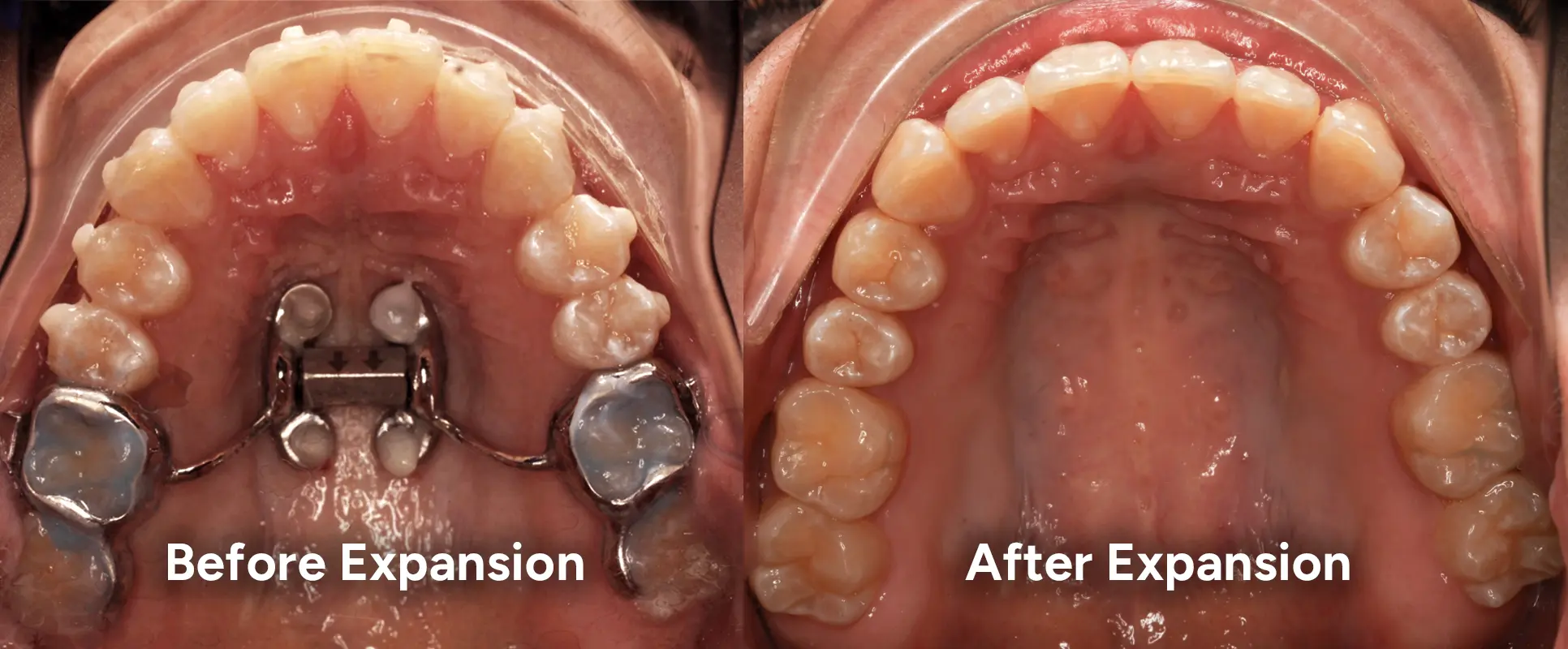 Before and after expansion views for bone supported treatment pathway