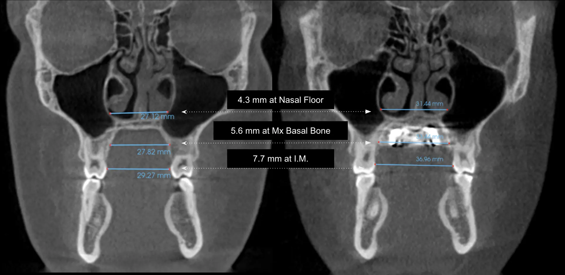 Before-and-after coronal imaging showing widening at the nasal floor and maxillary base with bone-supported expansion