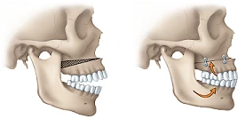 Illustration of upper jaw surgery used to correct an open bite