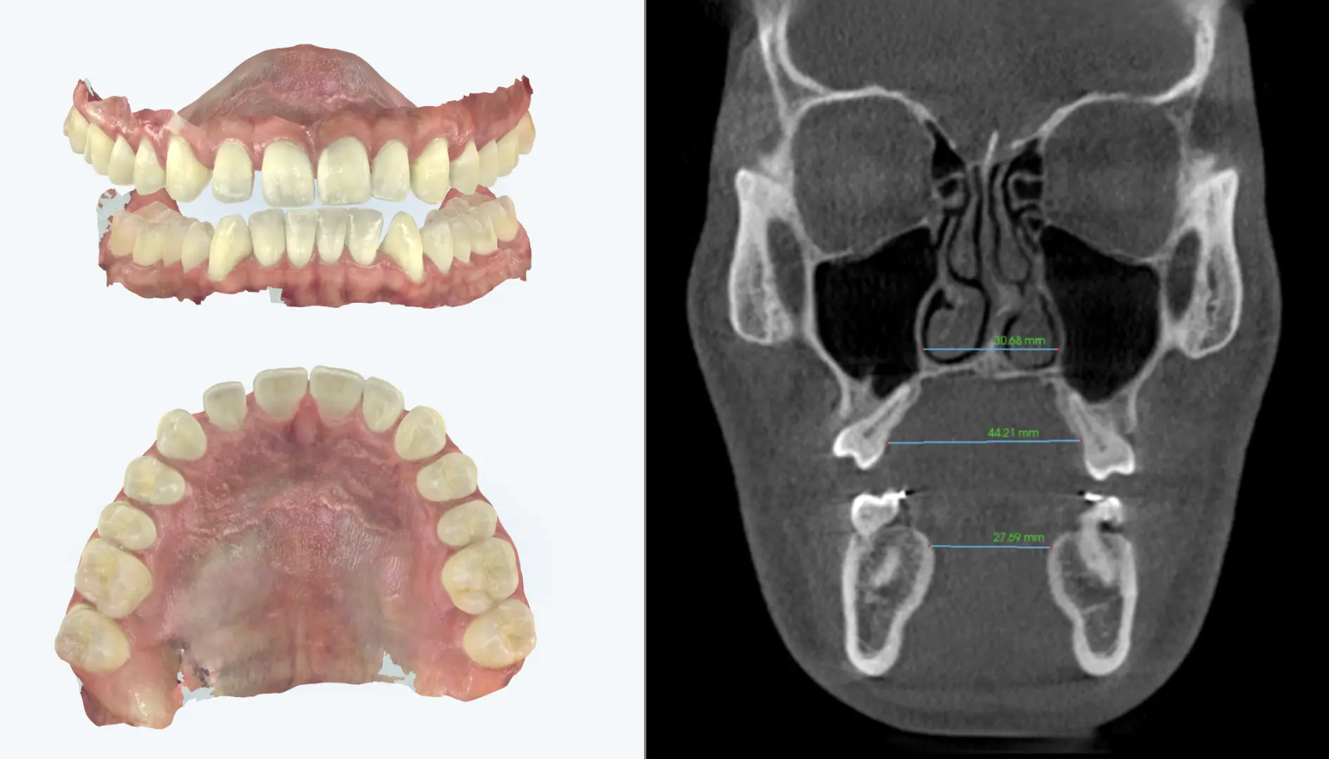 Dental models and coronal X-ray showing tooth-borne expansion with outward tipping instead of true skeletal widening