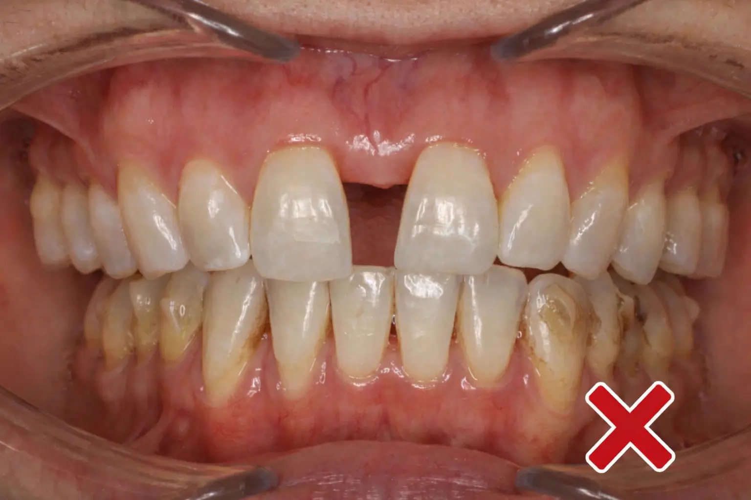 Traditional MARPE gap between front teeth during expansion